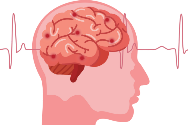 Let's Talk About Stroke for Everyone, Patients, Families, Caregivers ...