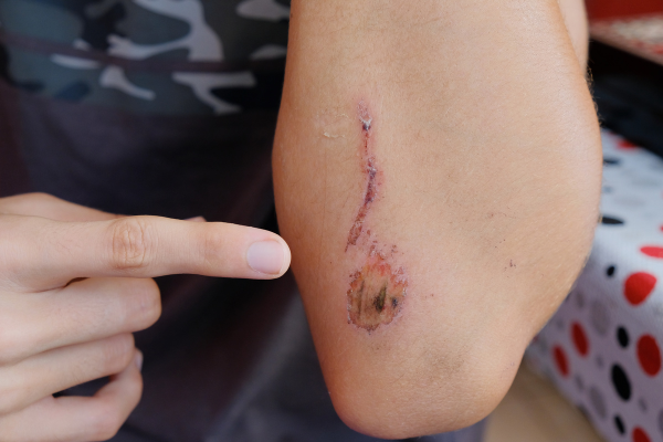 Maintaining Healthy Skin and Healing Wounds